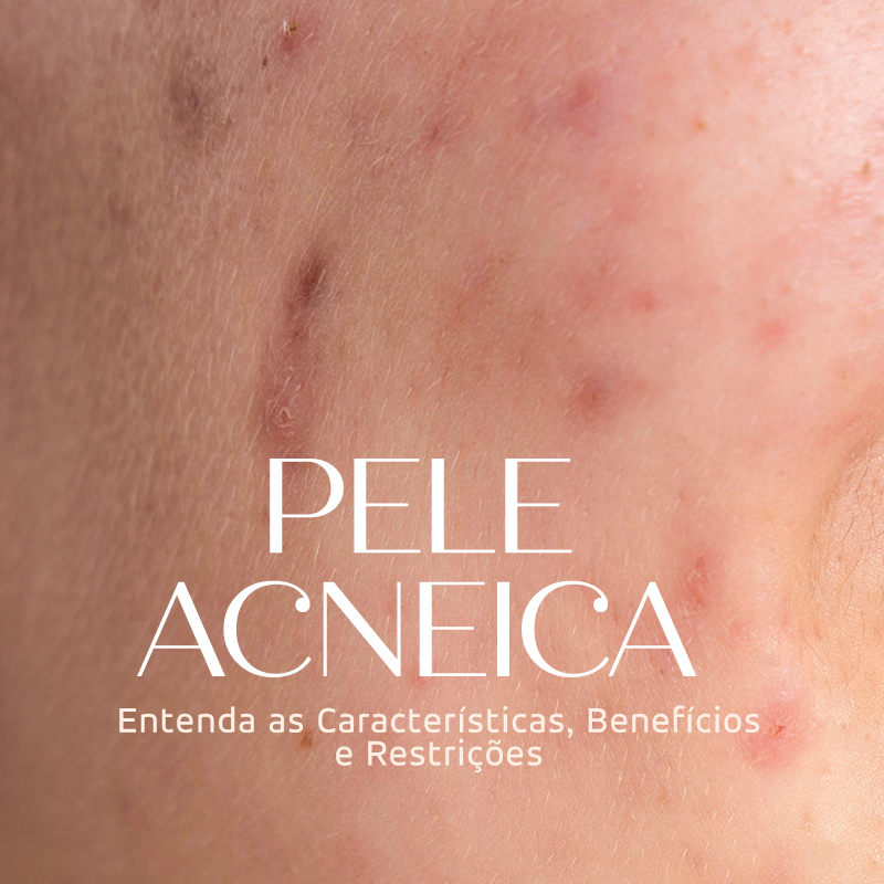 Pele Acneica: Entenda as Características, Benefícios e Restrições